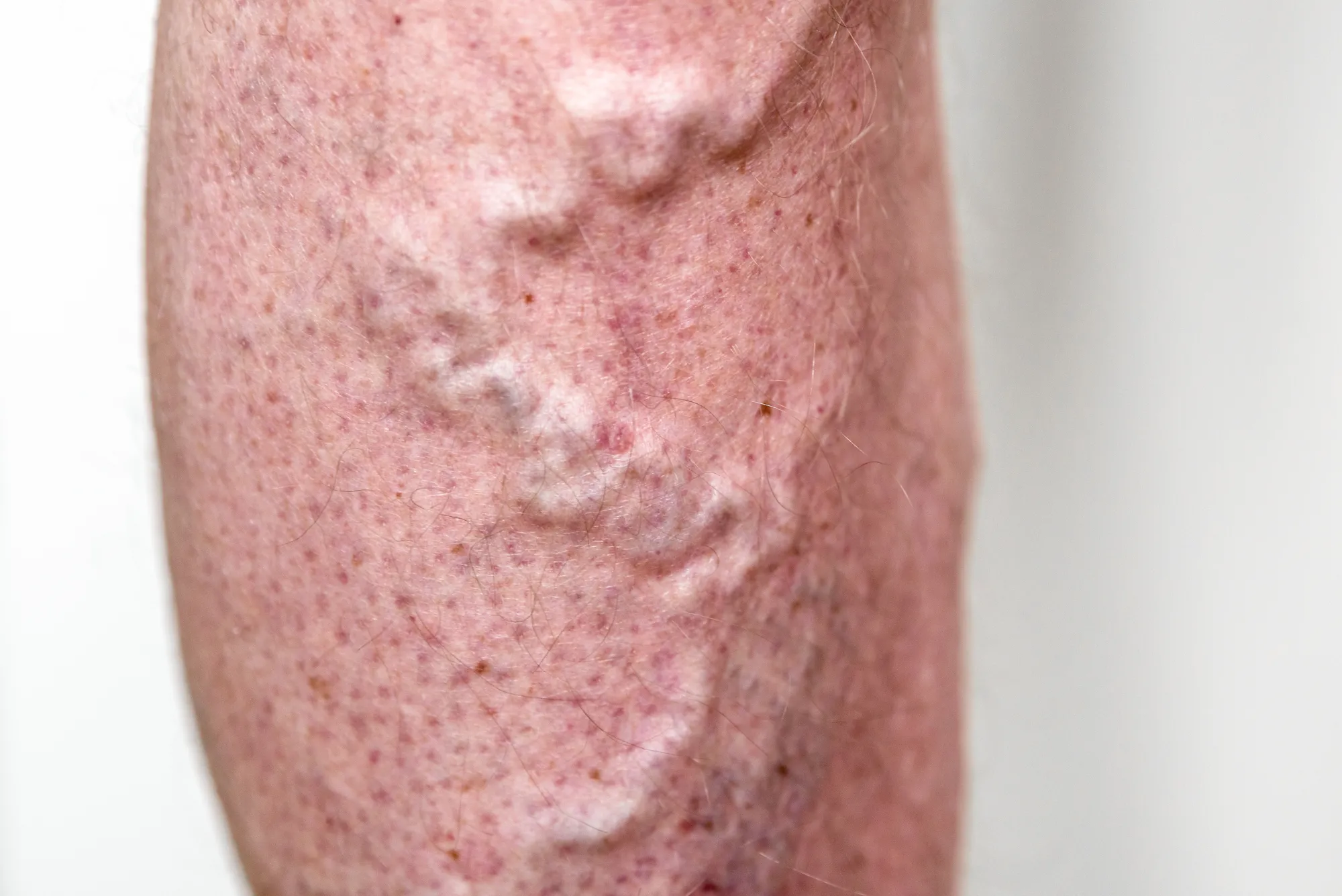 Varicose Veins Causes & Best Medical and Natural Treatments